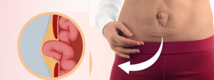 Hernia Surgery
